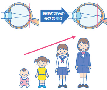 眼球の前後の長さの伸び